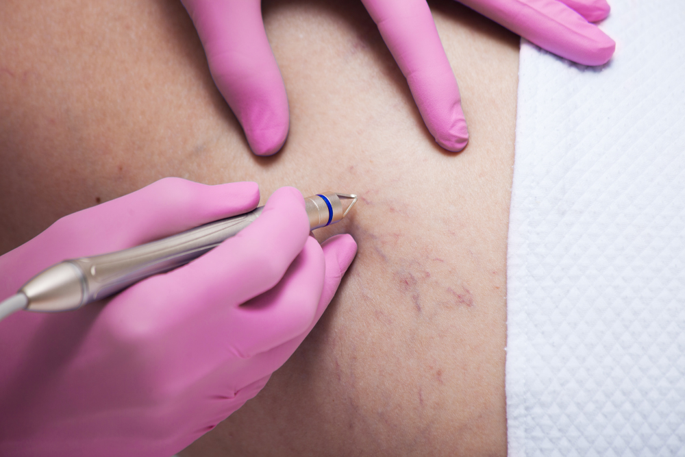 CAPILLARY VESSEL TREATMENT